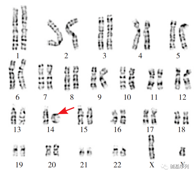 染色体组型 正常图片