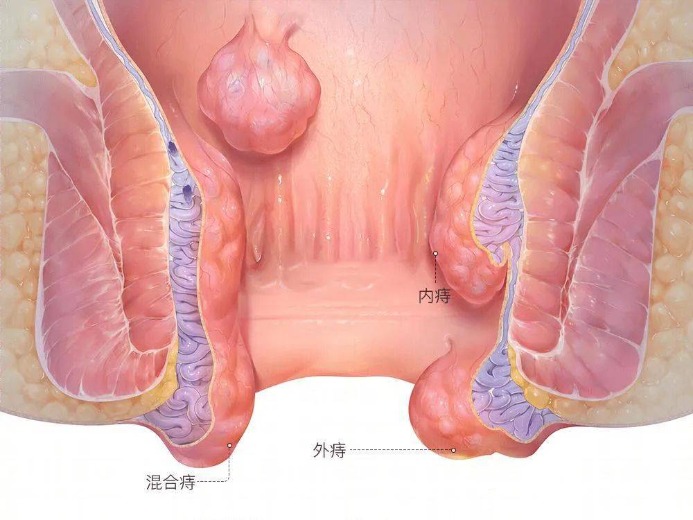 肛门息肉和痔疮有什么区别?