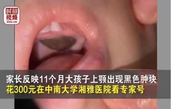 莲子壳粘在儿童嘴里，被专家诊断为肿瘤，湘雅医院回应 - 巴拉号