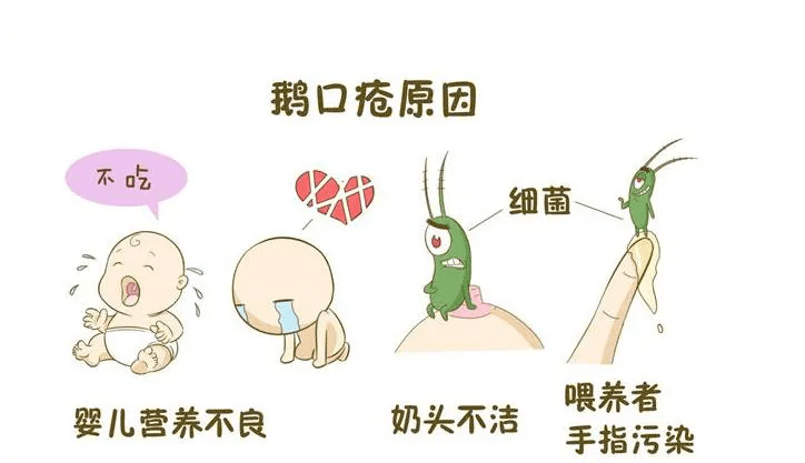 儿口腔病,口唇舌及颊黏膜有大小不等的白色乳凝块样小点或小片状物