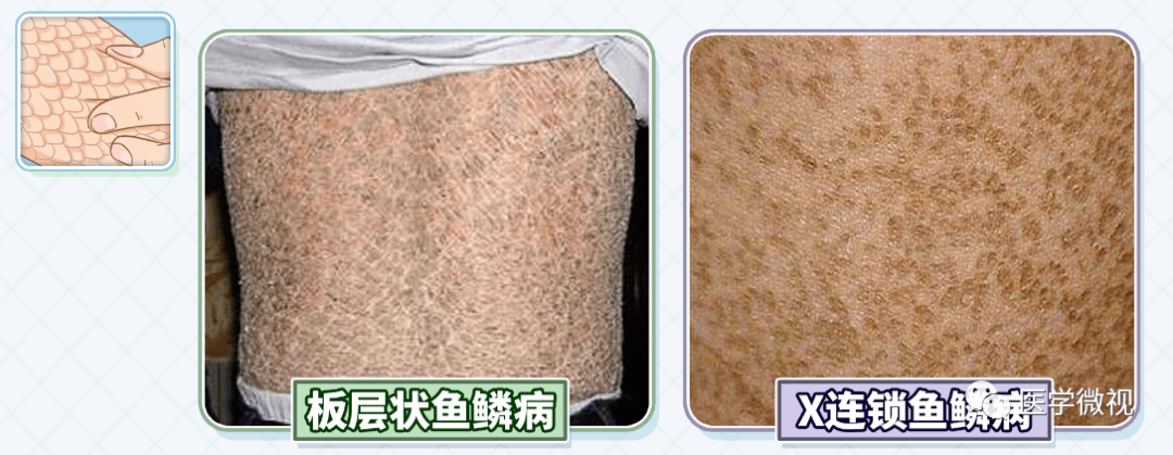 寻常型鱼鳞病患者,相对来说鳞屑比较规则,症状比较轻.