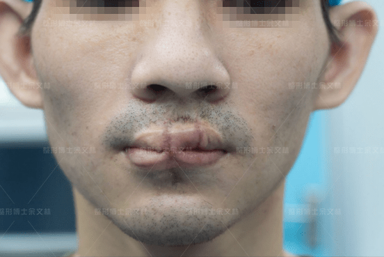 嘴巴缺了一大块?"挖"一块肉"补"回来!_组织_上唇_畸形