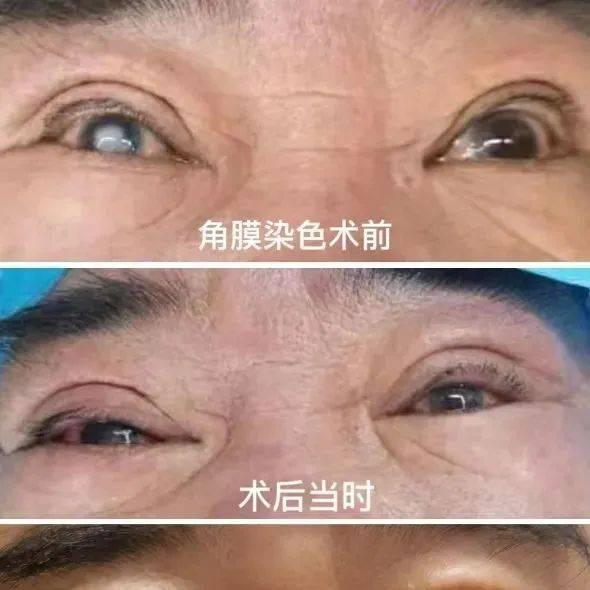 科普 | 角膜染色了解一下?_患者_白斑_进行