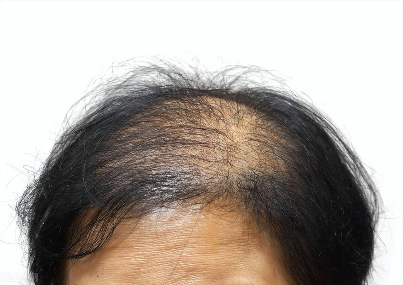 脱发是遗传的吗?