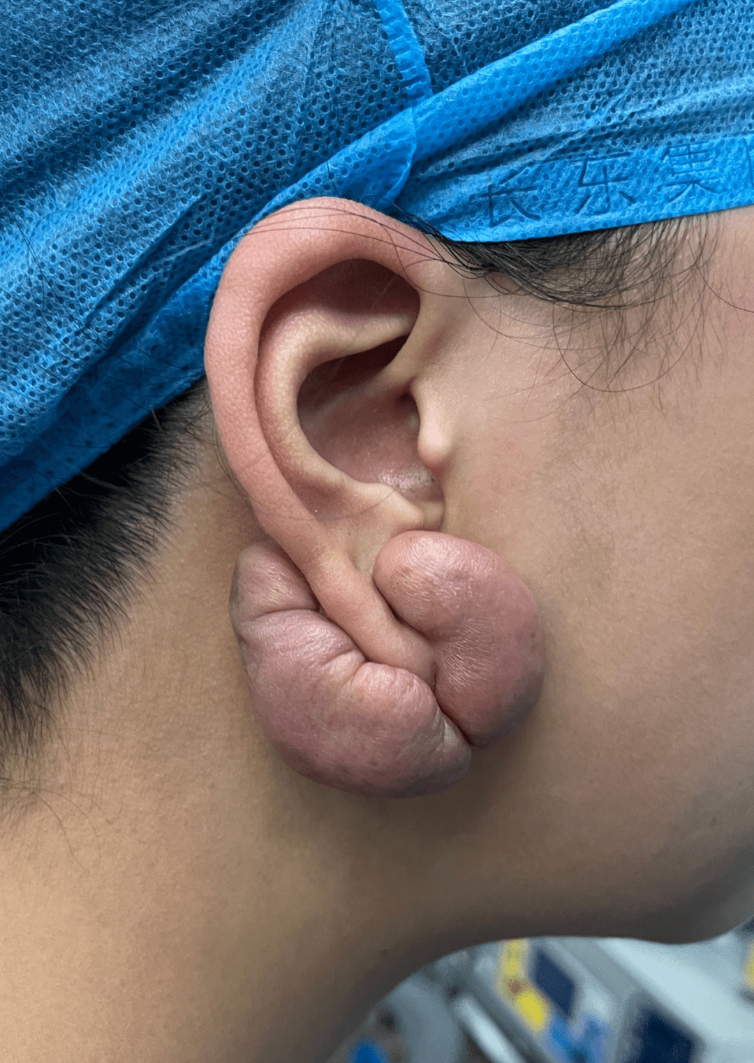 20岁女孩打耳洞长出腰果型肉疙瘩,医生:疤痕体质打耳洞要慎重