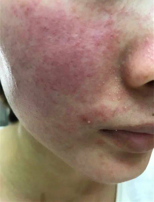 激素脸脸痒怎么办才能治好?_症状_药膏_面部