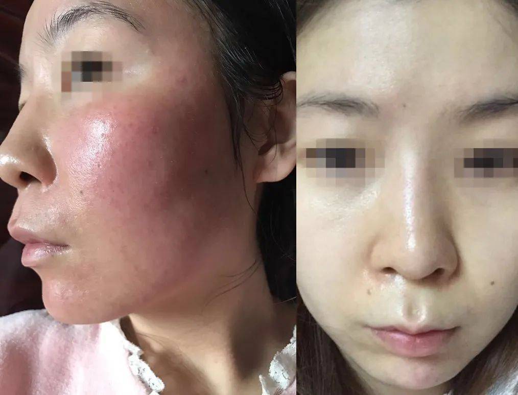 初颜净:长了一脸激素痘怎么办?脸上长了激素痘怎么办?_皮肤_治疗_症状