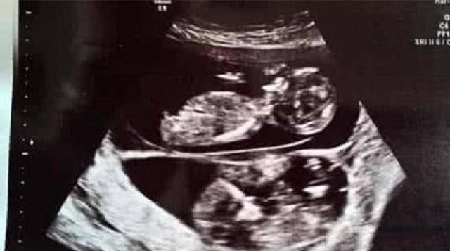双胞胎胚胎b超图片图片