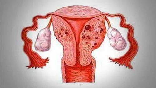 子宫腺肌瘤需要手术吗