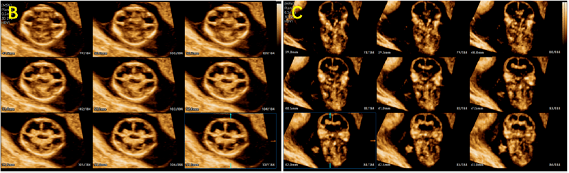 三胞胎早孕b超图片图片