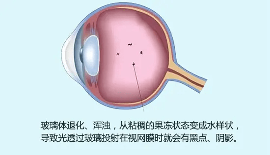 玻璃体混浊weiss环图片图片