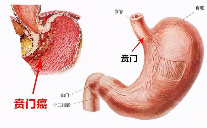 贲门癌晚期图片图片