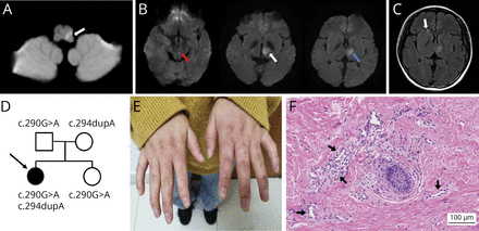 期刊精华丨neurology8月刊:cadasil,青年缺血性卒中,常压高氧_in_with