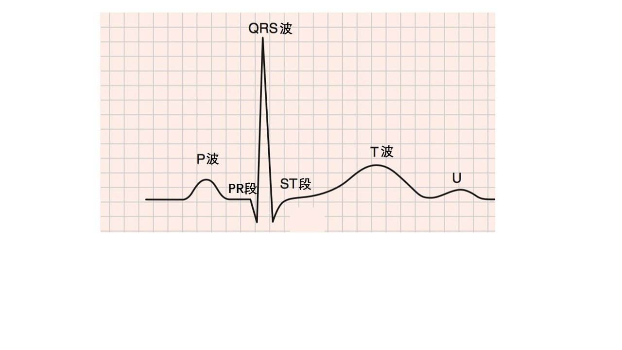 病理性q波心电图形图片