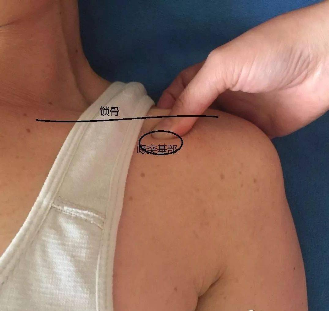 病患坐姿上肢下垂,诊疗者将手指放其喙突的上方,从喙突尖端开始往内侧