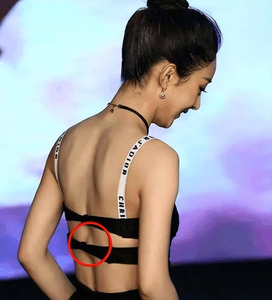 导致赵丽颖的后背上,形成了一个拳头大小的"血栓".