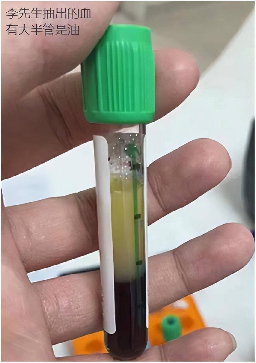 抽出来的血里有大半管都是油?_李先生_生活_方式