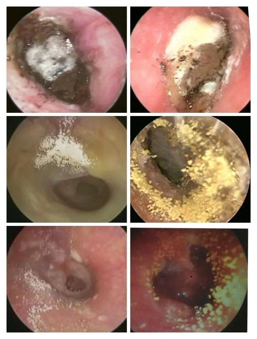 耳道_耳屎_真菌性