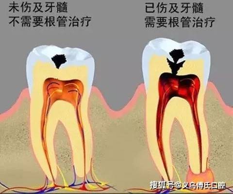 还伴随着剧烈疼痛，牙神经病变这时得根管治疗（挑牙神经），来挽救伤痕累累的牙齿。