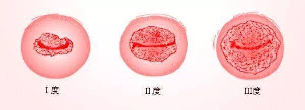 阴道炎演变到宫颈ai的过程是这样的,好怕怕!