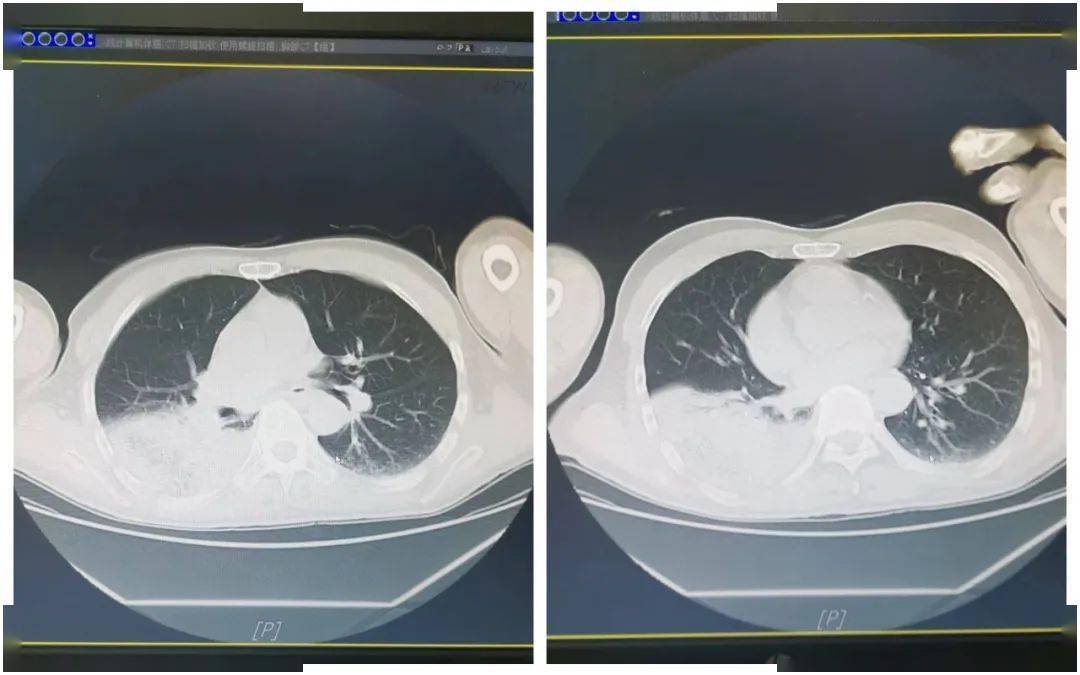 患者胸部ct示右下肺肺炎鹦鹉热是一种人畜共患的传染病,主要是由革兰