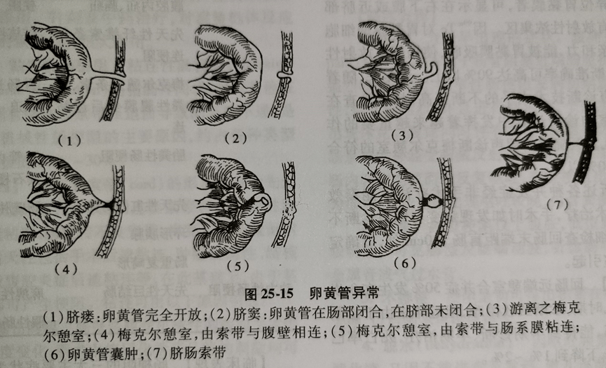 端萎缩退化,若脐端已退化,肠端未退化则形成一盲囊,称为回肠远端憩室