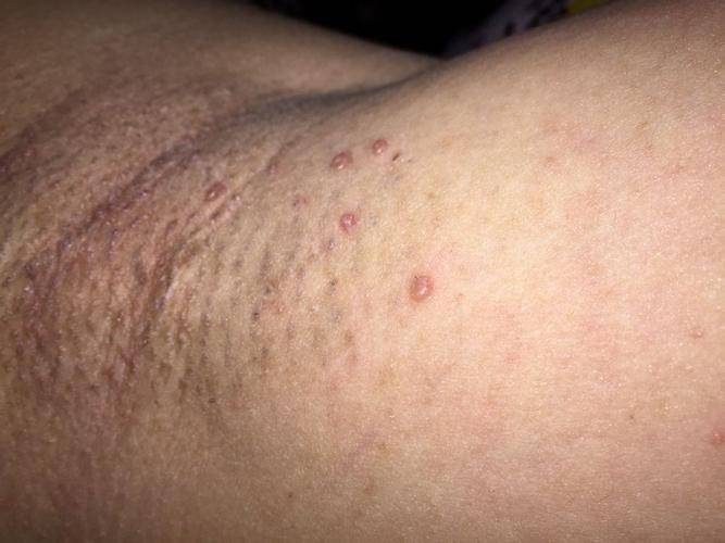 脖子和腋下的"小肉粒"是什么?可以用手直接揪掉吗?建议了解下_皮肤_饮