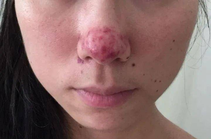 别把"玫瑰痤疮"当成普通"青春痘"_工作_皮肤_影响