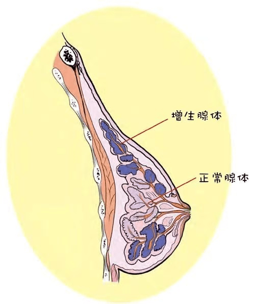 乳房包块是什么意思图片