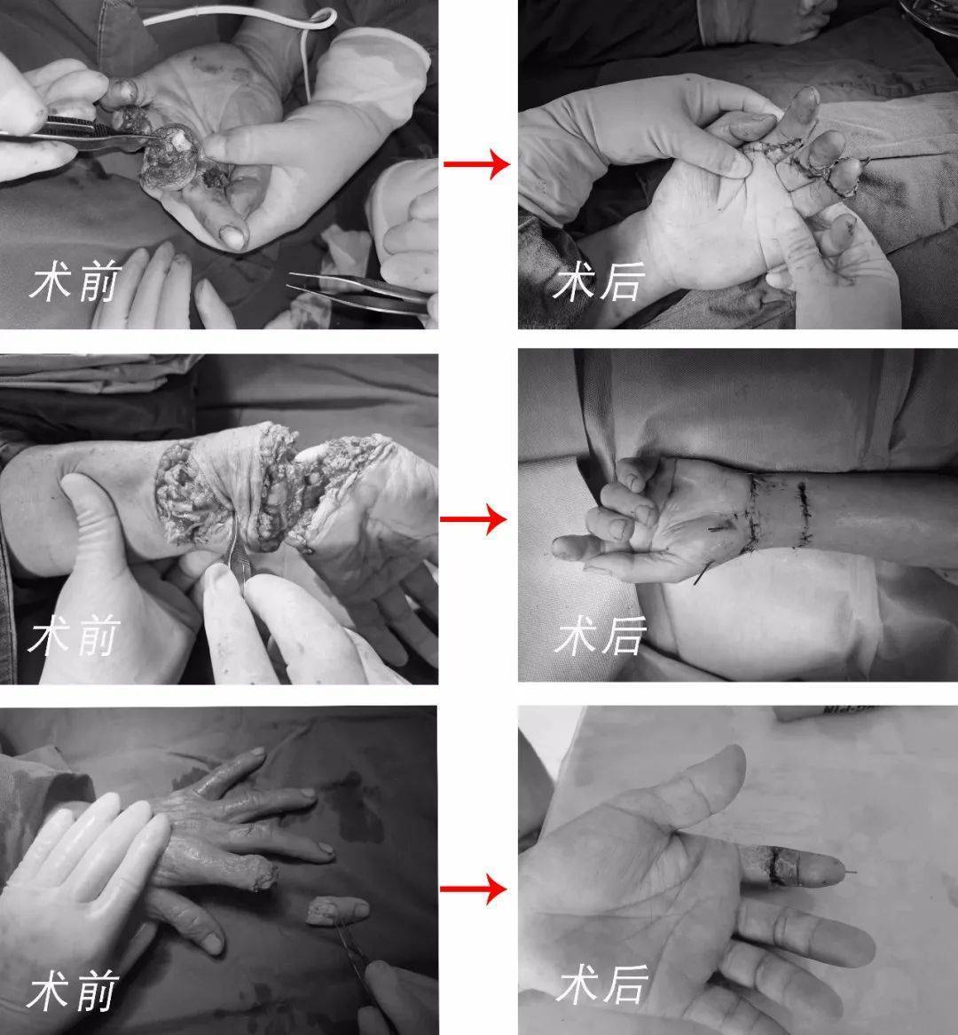 一男子手指不慎被机器割断,鲜血淋漓~_患者_进行_手术