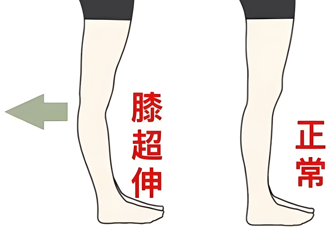 膝过伸——偏瘫患者康复路上的绊脚石_膝关节_训练_控制