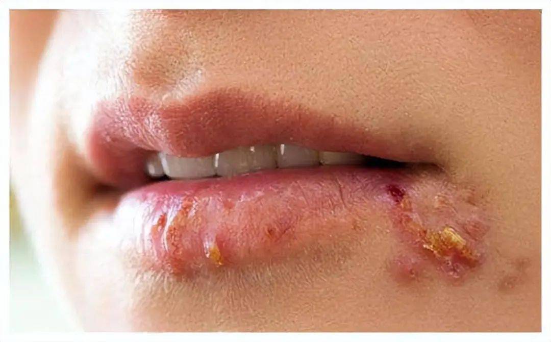 嘴巴周围时不时出现"几个水泡",或许不是"上火",应注意_疾病_病毒