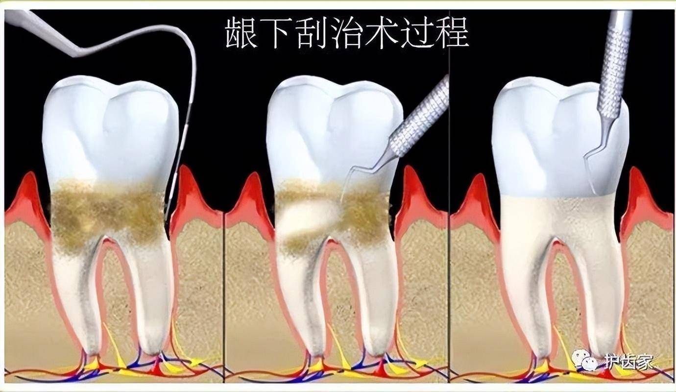 全口洁治术分为龈上洁治术和银下刮治术,部分较严重的牙周病患者,牙龈