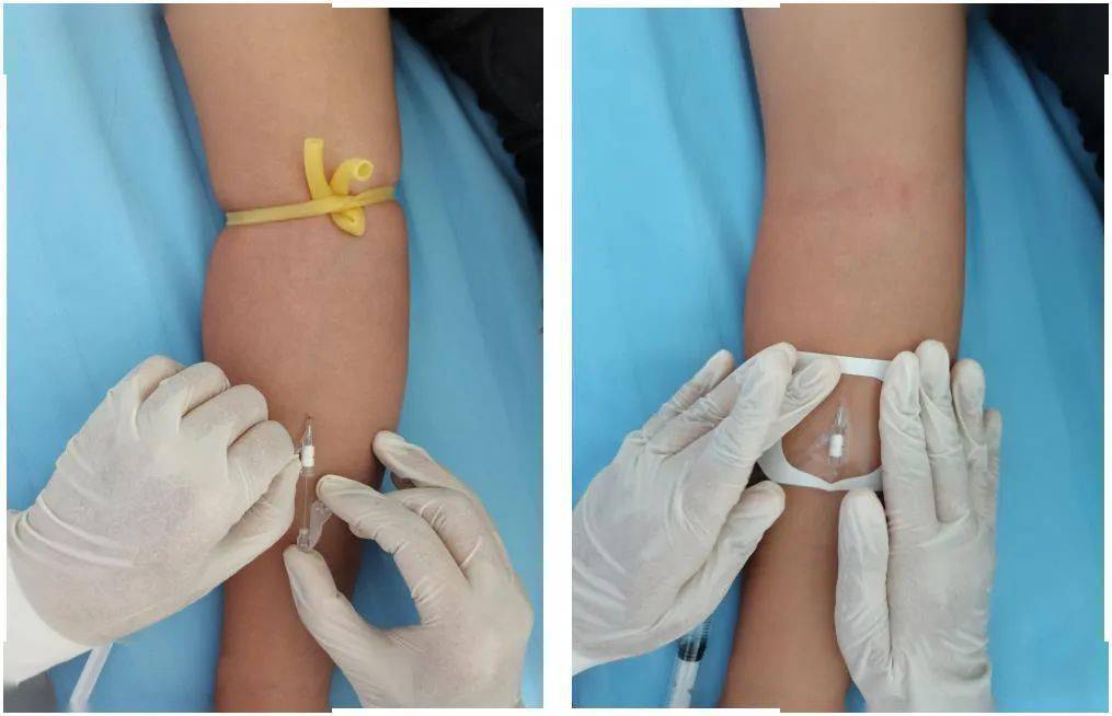 使用留置针过程中怎么规避及减少并发症?