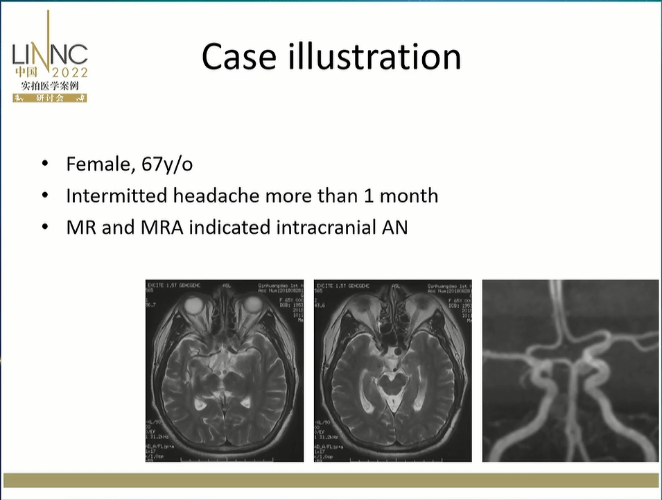 8f envoy导引导管 6f 115cm navien中间导管建立通路,synchro14微导丝