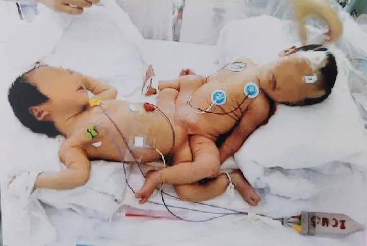 22年前浙江首例连体婴分离手术的存活者现在过得怎么样了(连体婴儿是怎么产生