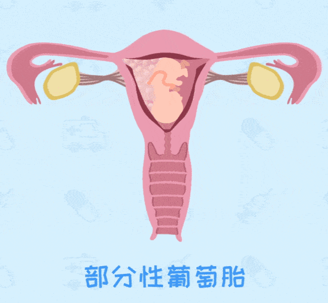 葡萄胎是什么原因导致的?能做试管婴儿吗?