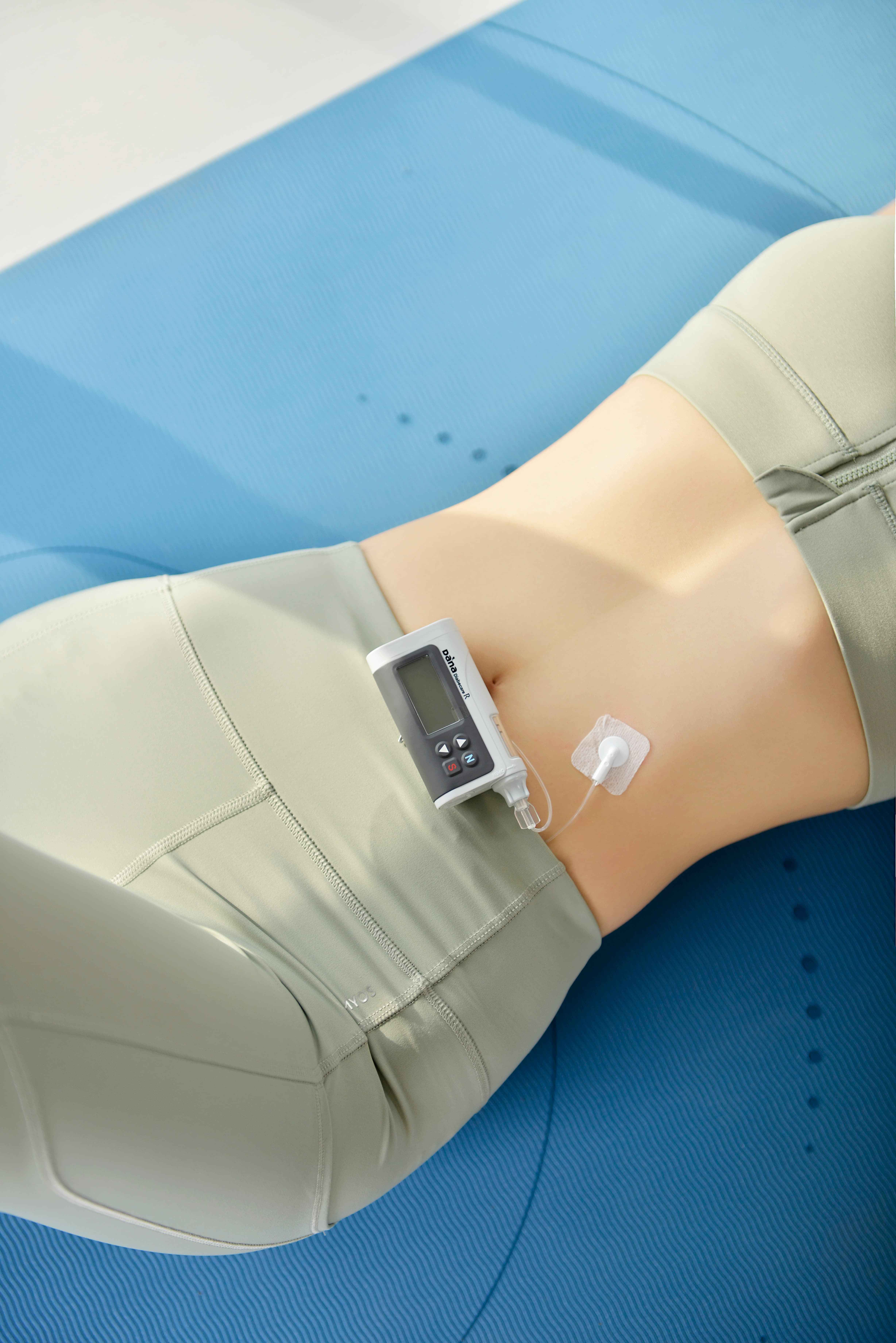 一台胰岛素泵可以用几年?_血糖_问题_马达