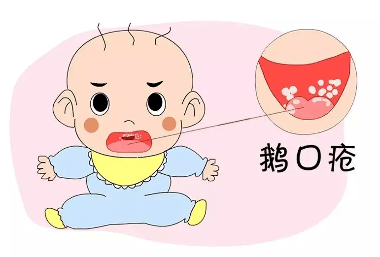 科普丨新生婴儿需要口腔清洁?口腔护理别忽略!_小宝宝_鹅口疮_残留