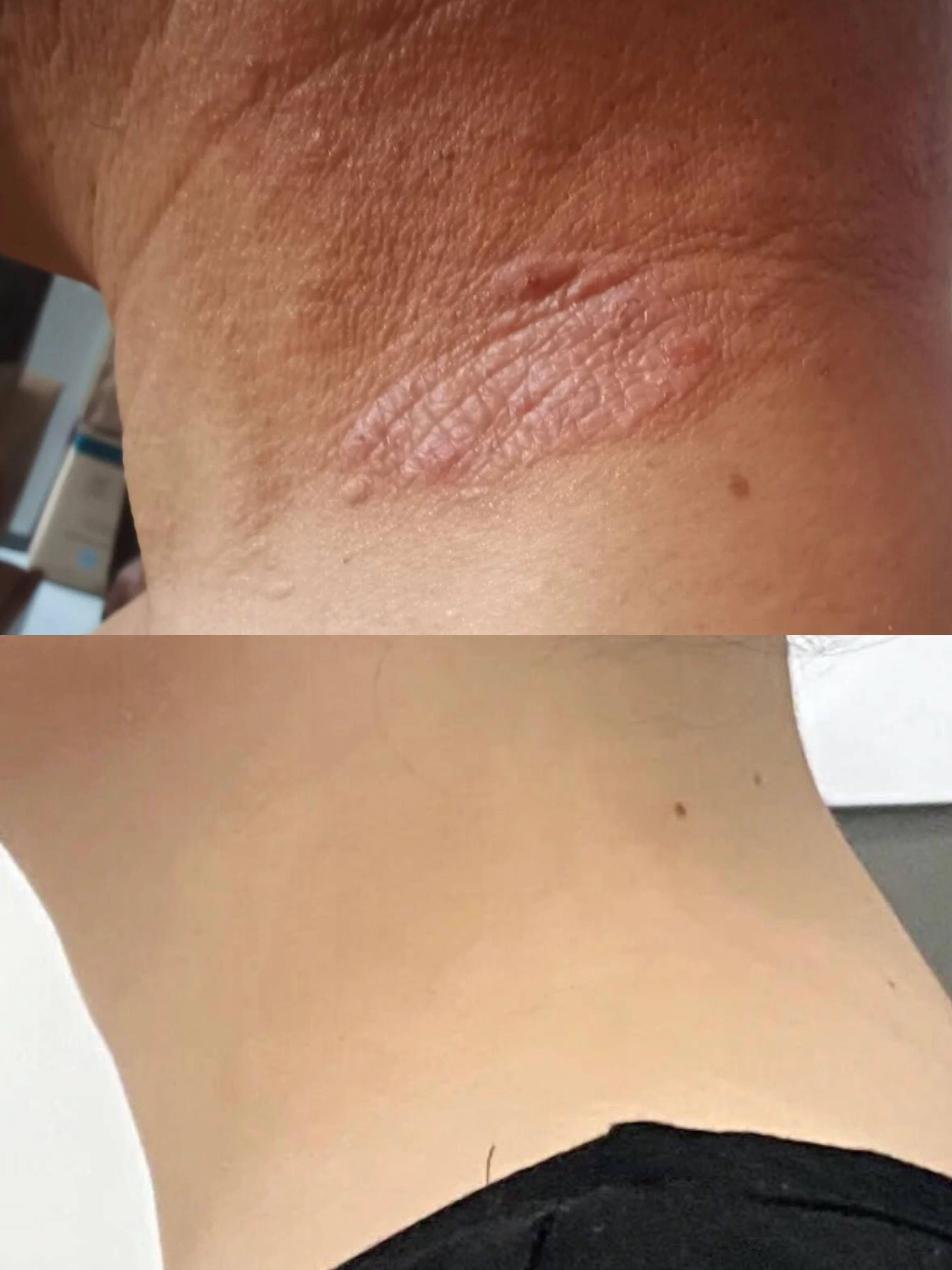 皮肤增厚,瘙痒不止?过来人教你轻松解决小妙招,皮炎几天就恢复!