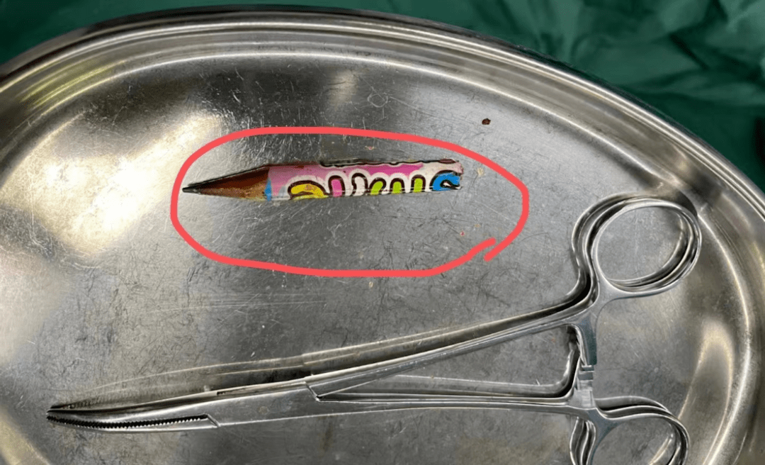 乐清8岁女孩摔了一跤,半截铅笔扎进胸腔……_孩子_进行_物品