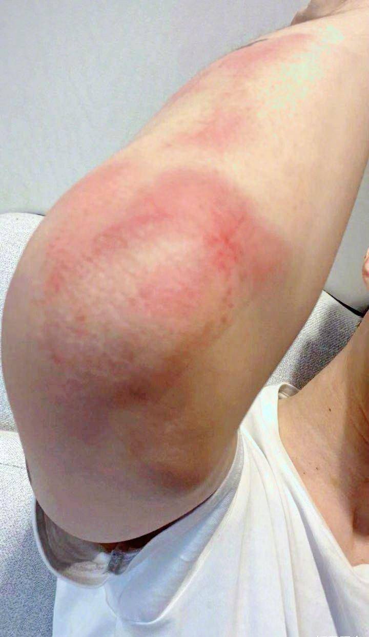 林家栋受伤额头缝10针无人问,范丞丞摔倒胳膊红肿有人疼,为什么?