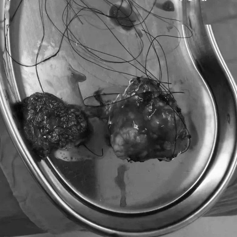 我院耳鼻咽喉科顺利完成一台腮腺巨大肿物切除 面神经解剖术_手术