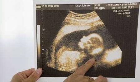 其实目前最准确的方法也就只有b超和染色体了,但是我国非医学指征的