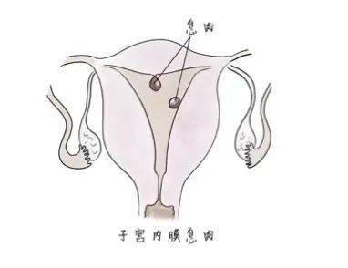 阴道淋漓出血3个月,原来竟是子宫内膜息肉!_刘女士_女性_情况