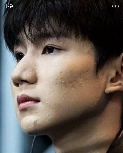 19岁王源"爆痘"严重,被喊话赶快戒烟,痘痘跟这有关系?_皮肤_影响_孩子