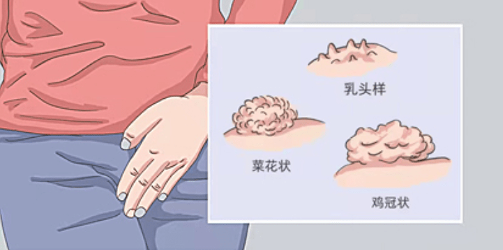 郑州合心医院:年轻人需要知道的尖锐湿疣的早期症状都有哪些?