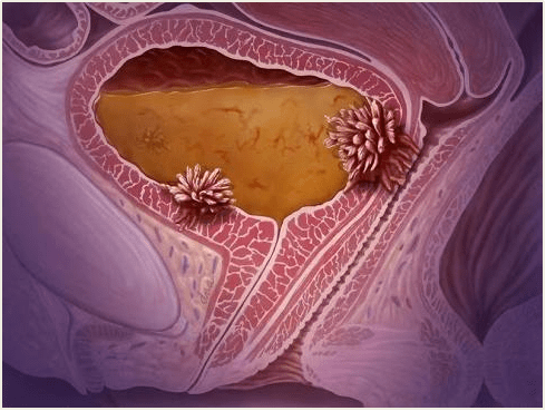 有的膀胱肿瘤长得像水草,漂浮在膀胱中,这通常是一个很早期的膀胱癌
