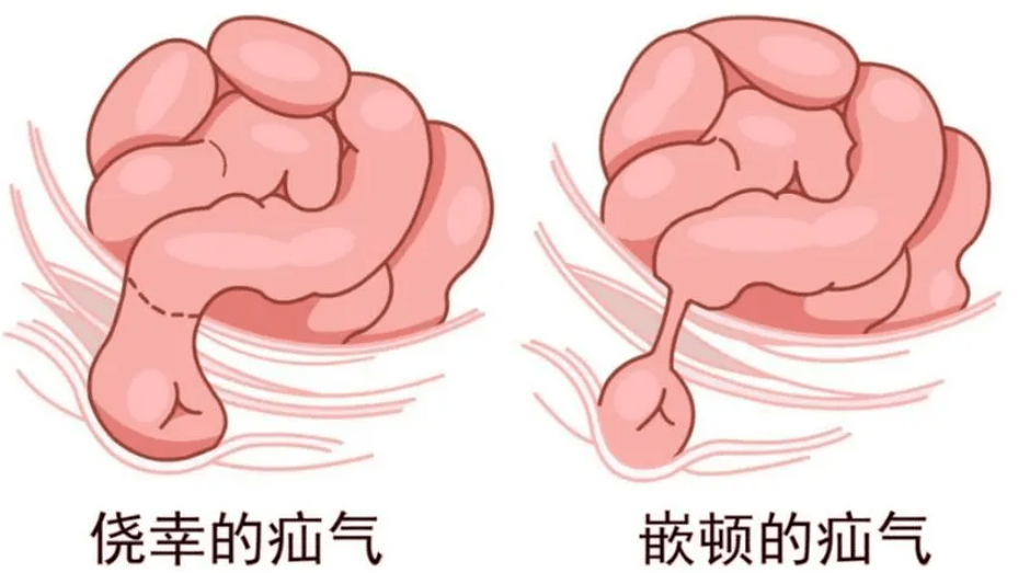 睾丸疝气是什么病图片