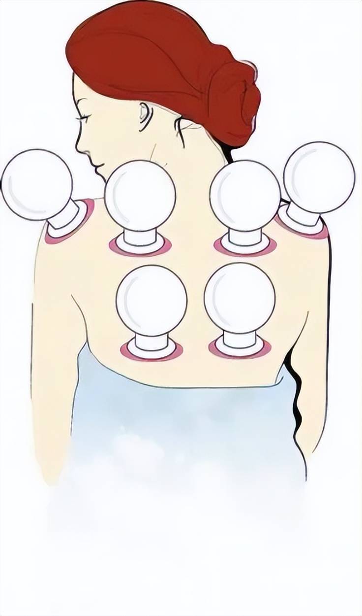 王女士去中医理疗馆拔火罐,店主告诉王女士满背火罐一共159元